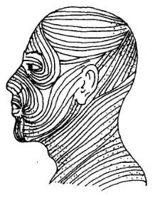 4 Principles for selecting incision sites in cosmetic surgery 2 Figure 3 2 Relationship between the incision and skin creases